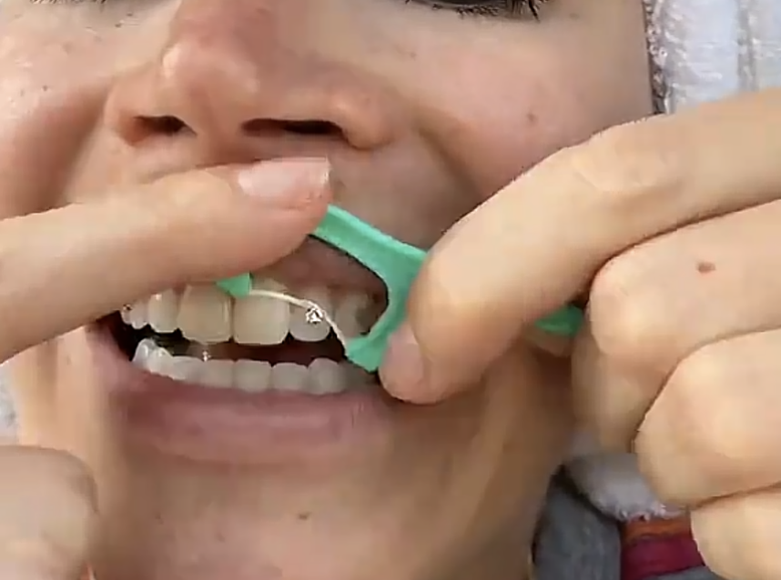 A person with light skin is adjusting a dental retainer or braces with a green orthodontic tool in their mouth.