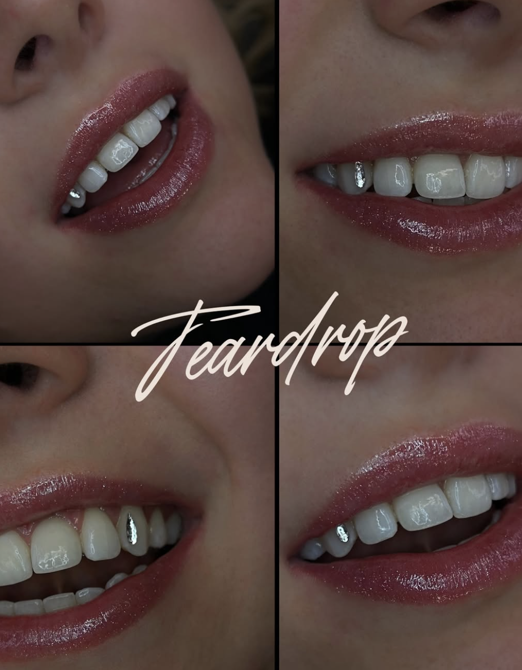 Close-up collage of smiling woman's lips and teeth, showcasing dental work with metal implants or fillings and glossy pink lipstick, with "Feardrop" written across the center.