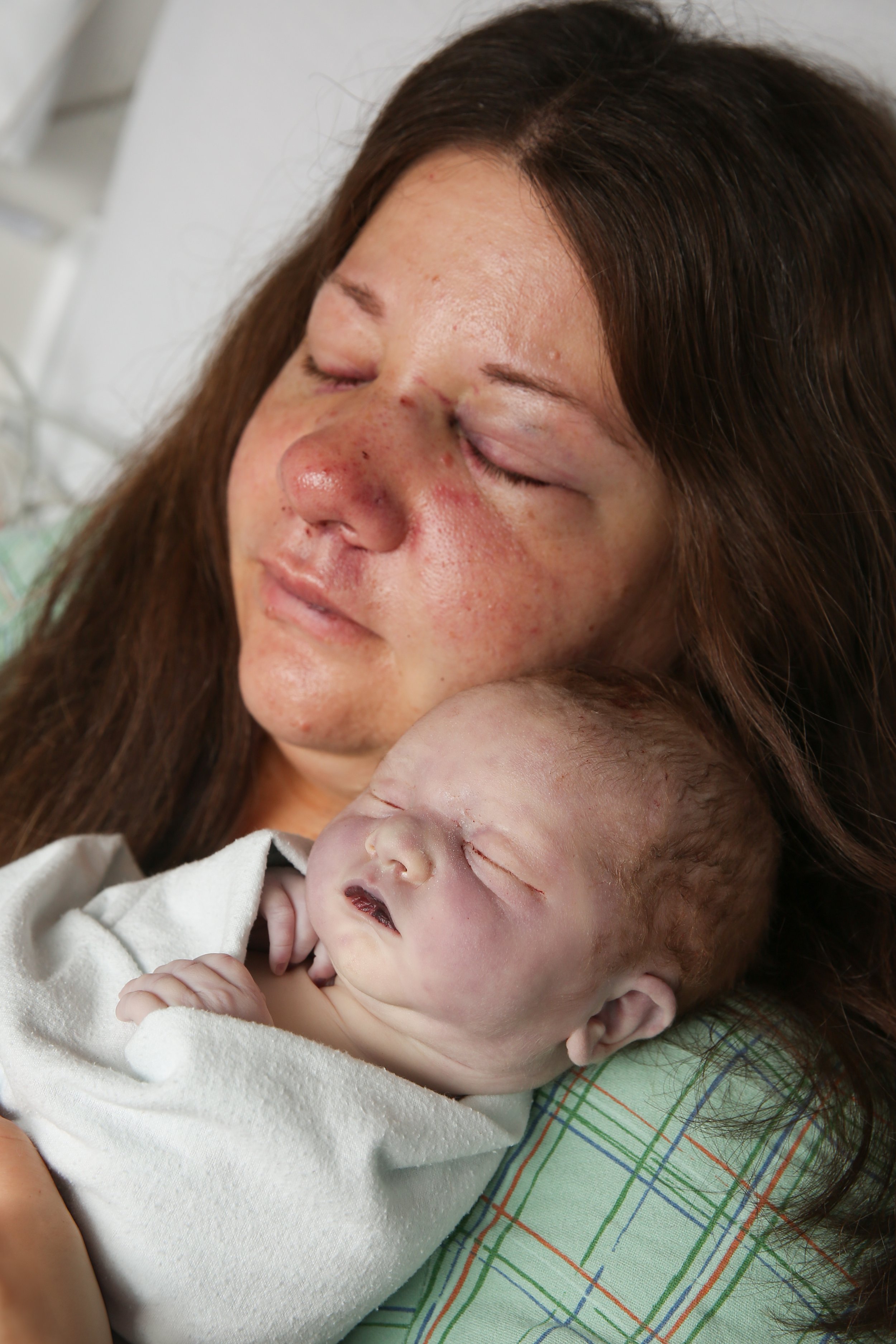 A woman with post-surgery bruises and swelling holding a newborn baby with a swollen, bruised face.