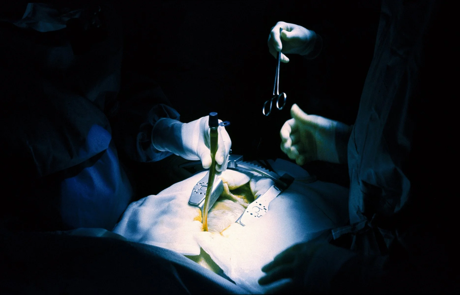 Surgeons performing surgery in an operating room with dark lighting, using surgical tools on a patient.