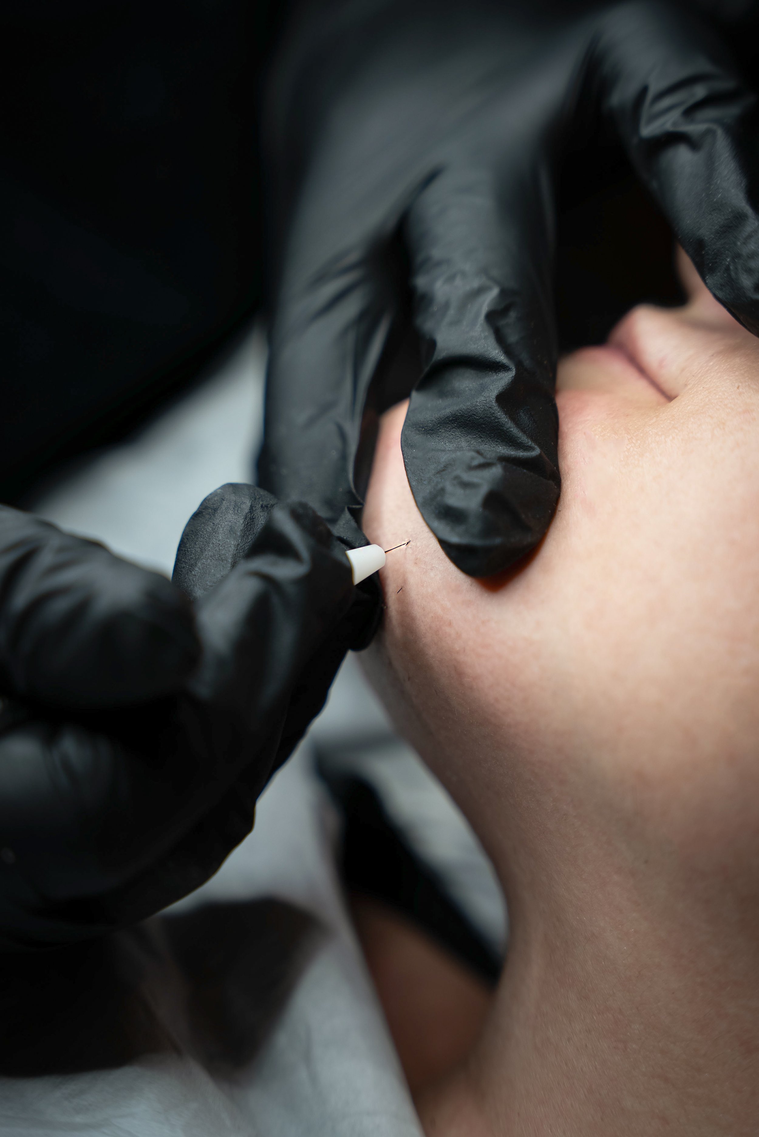 Close-up of a person receiving an injection in their cheek, with a healthcare professional wearing black gloves administering the shot.