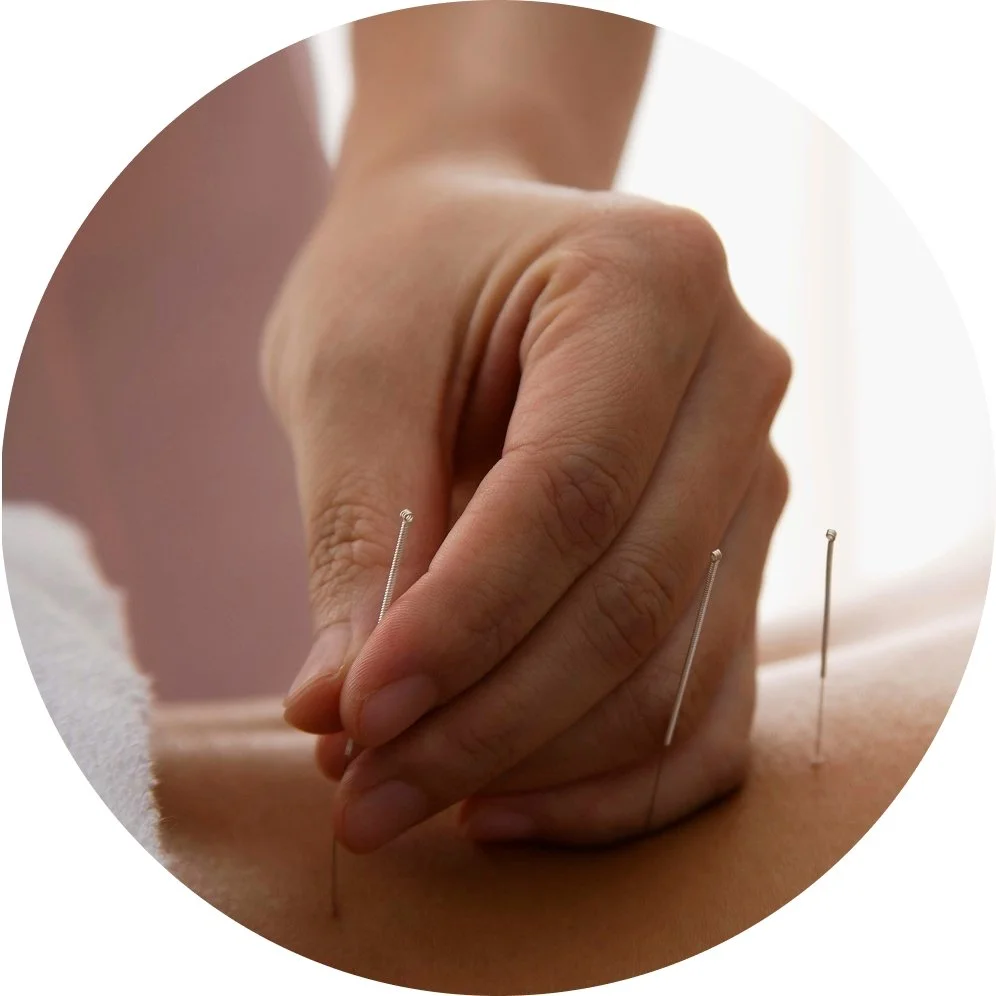 Person receiving acupuncture treatment with thin needles inserted into their back.