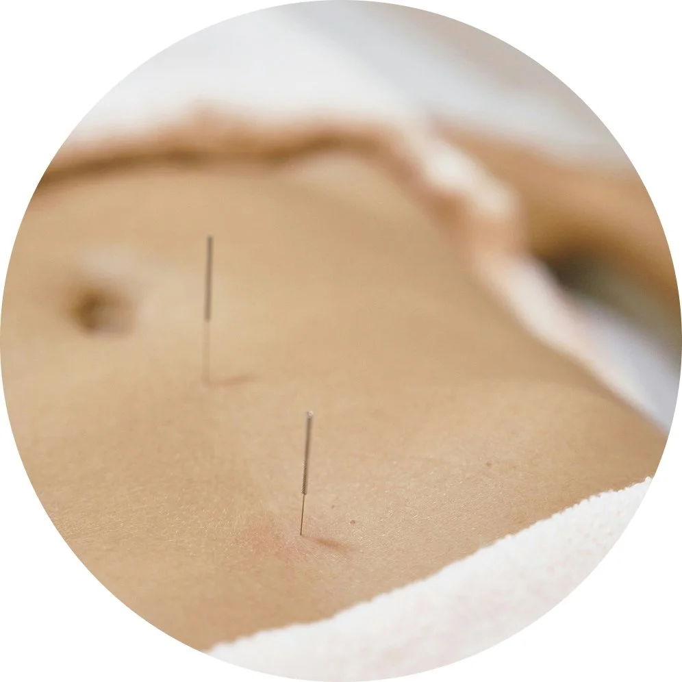Close-up of acupuncture needles inserted into a person's skin during a treatment.