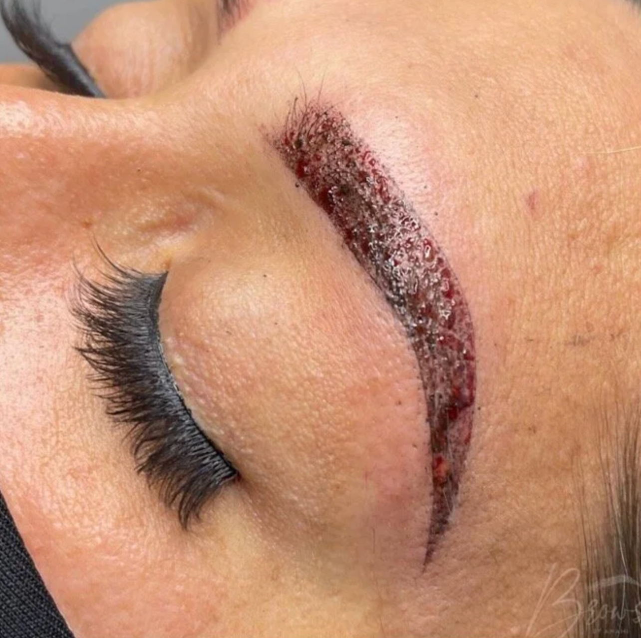 Close-up of a person's face showing a bad example of aftercare and issues with tattoo