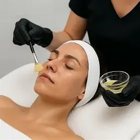 Chemical Peel