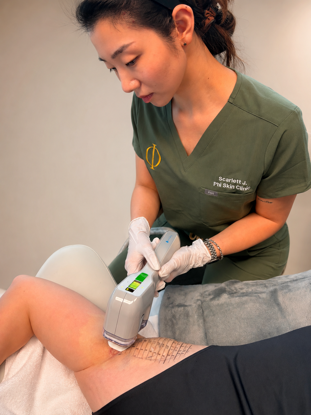 Scarlett, Medical Aesthetician at Phi Skin Clinic, performing a miraDry® treatment for underarm sweat and odour reduction on a patient in Vancouver.
