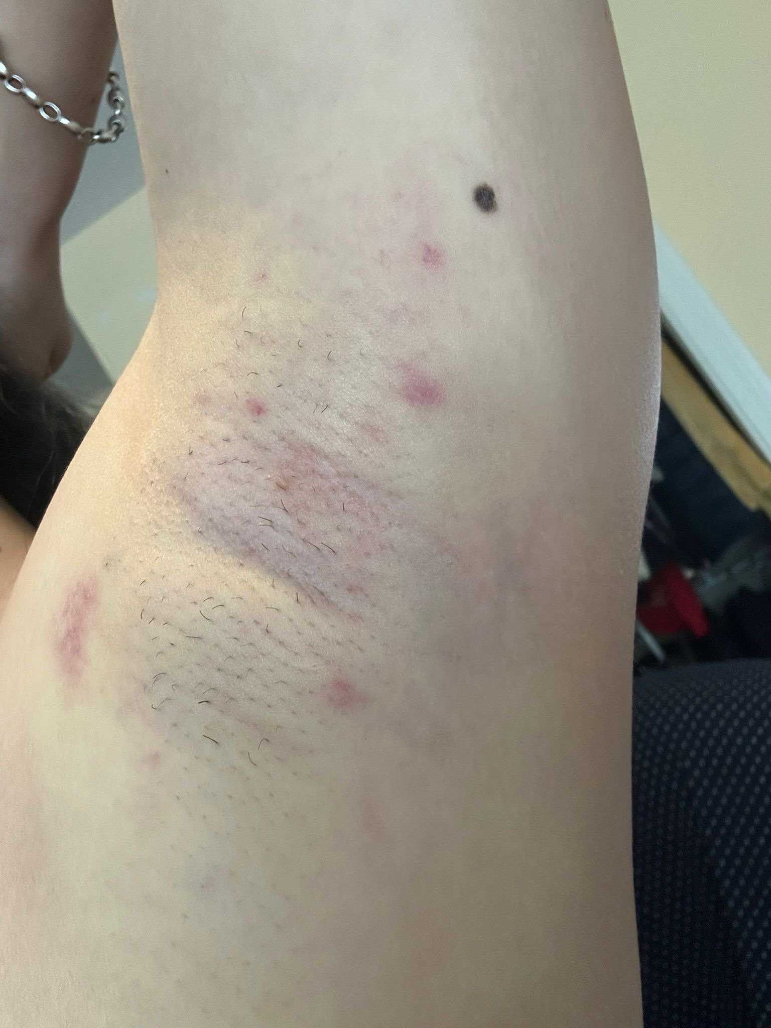 Scarlett's underarm on Day 2 after miraDry treatment, showing temporary bruising and swelling during recovery.