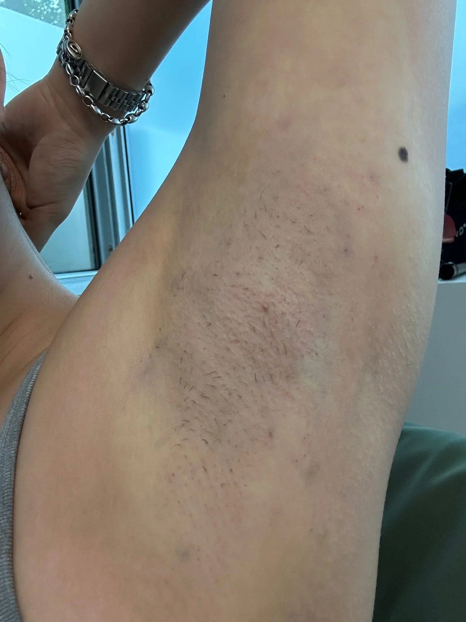 Scarlett's underarm immediately after miraDry treatment at Phi Skin Clinic in Vancouver, BC.