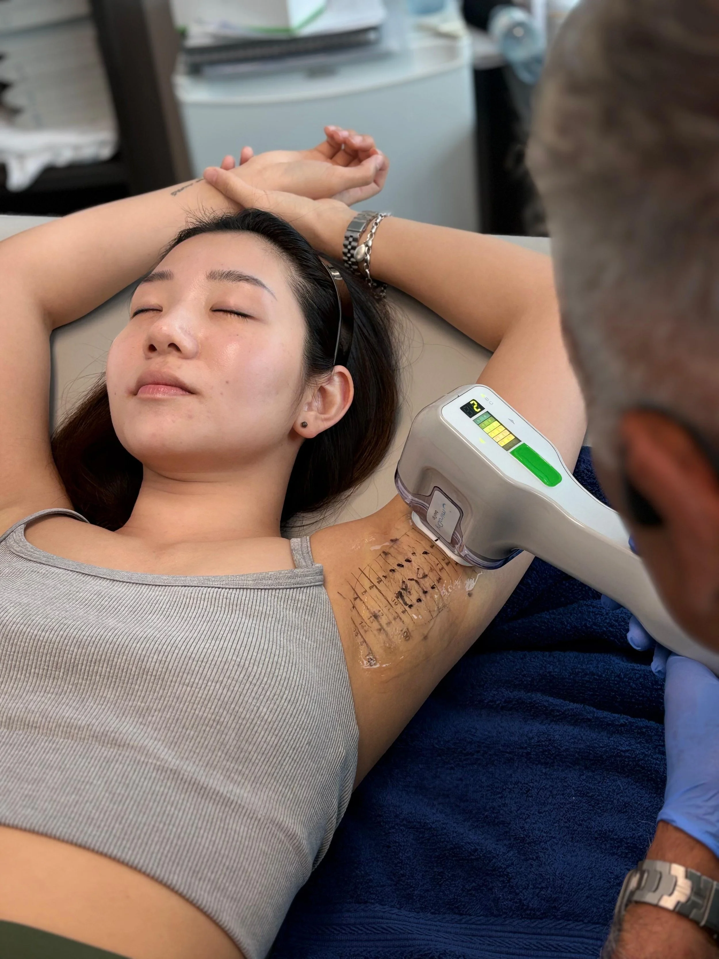 Scarlett receiving miraDry treatment at Phi Skin Clinic in Vancouver, BC, with the handpiece positioned on the underarm treatment area.