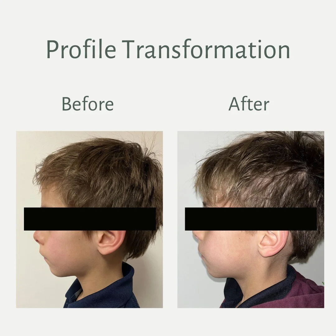 Expansion creates the space. Myofunctional therapy teaches the body how to use it. ✨

By pairing palatal expansion with myofunctional therapy, this patient has already seen major changes in both function and facial profile.

As the airway improves an
