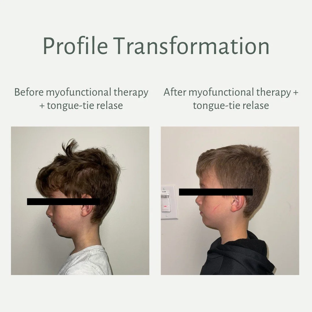 Before ➝ After
&bull; Improved head + neck alignment
&bull; Reduced forward head posture
&bull; Lower jaw and chin appear more forward and balanced
&bull; More defined side profile

Along with the visual changes, this patient experienced functional i