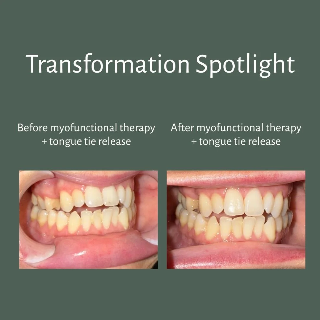 Did you know that tongue posture can influence tooth position over time? 👅

When the tongue rests between the teeth or pushes against them during swallowing, it can contribute to an open bite and flaring of the front teeth.

After myofunctional ther
