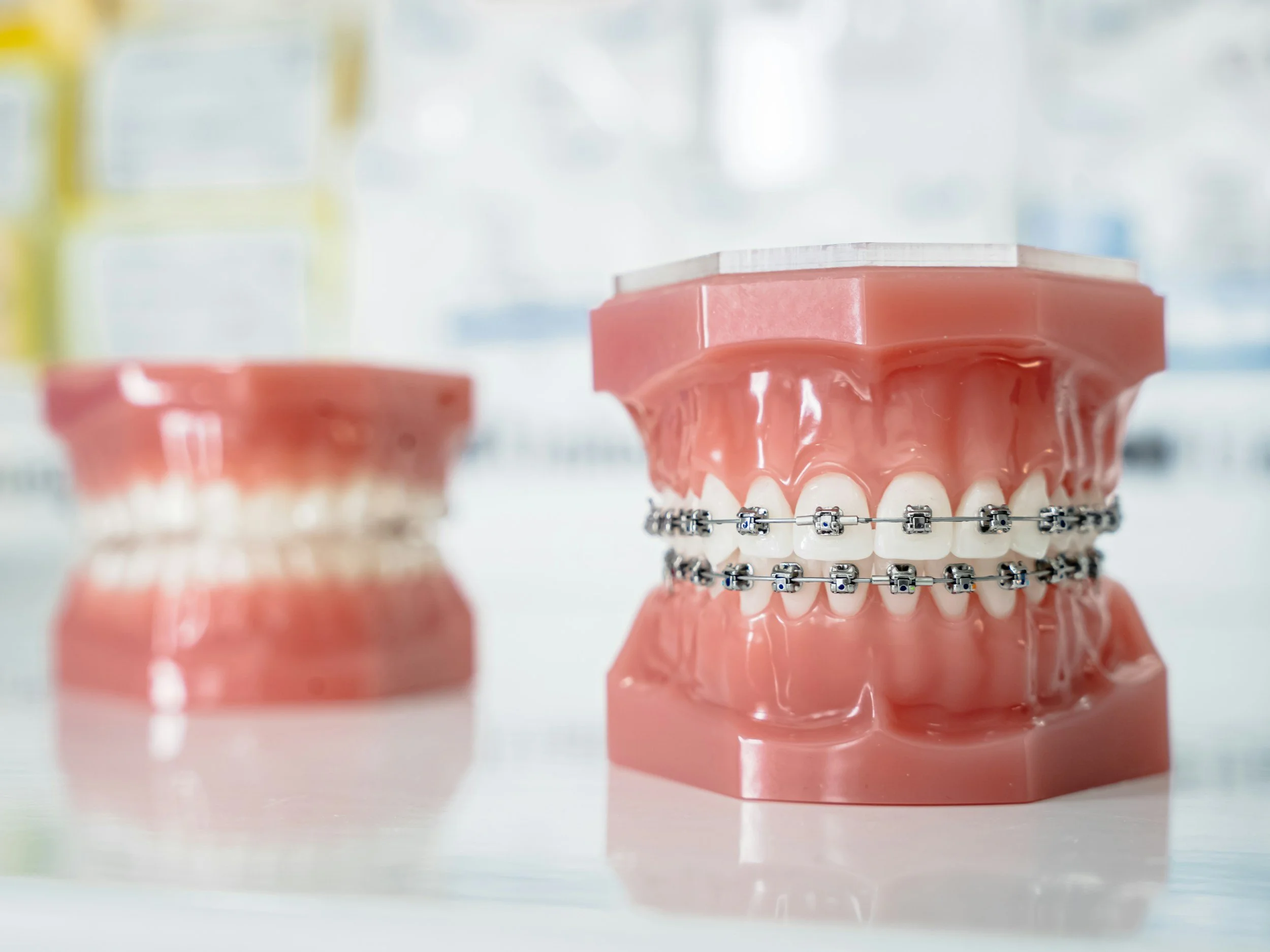 A dental model showing teeth with metal braces and an orthodontic archwire.