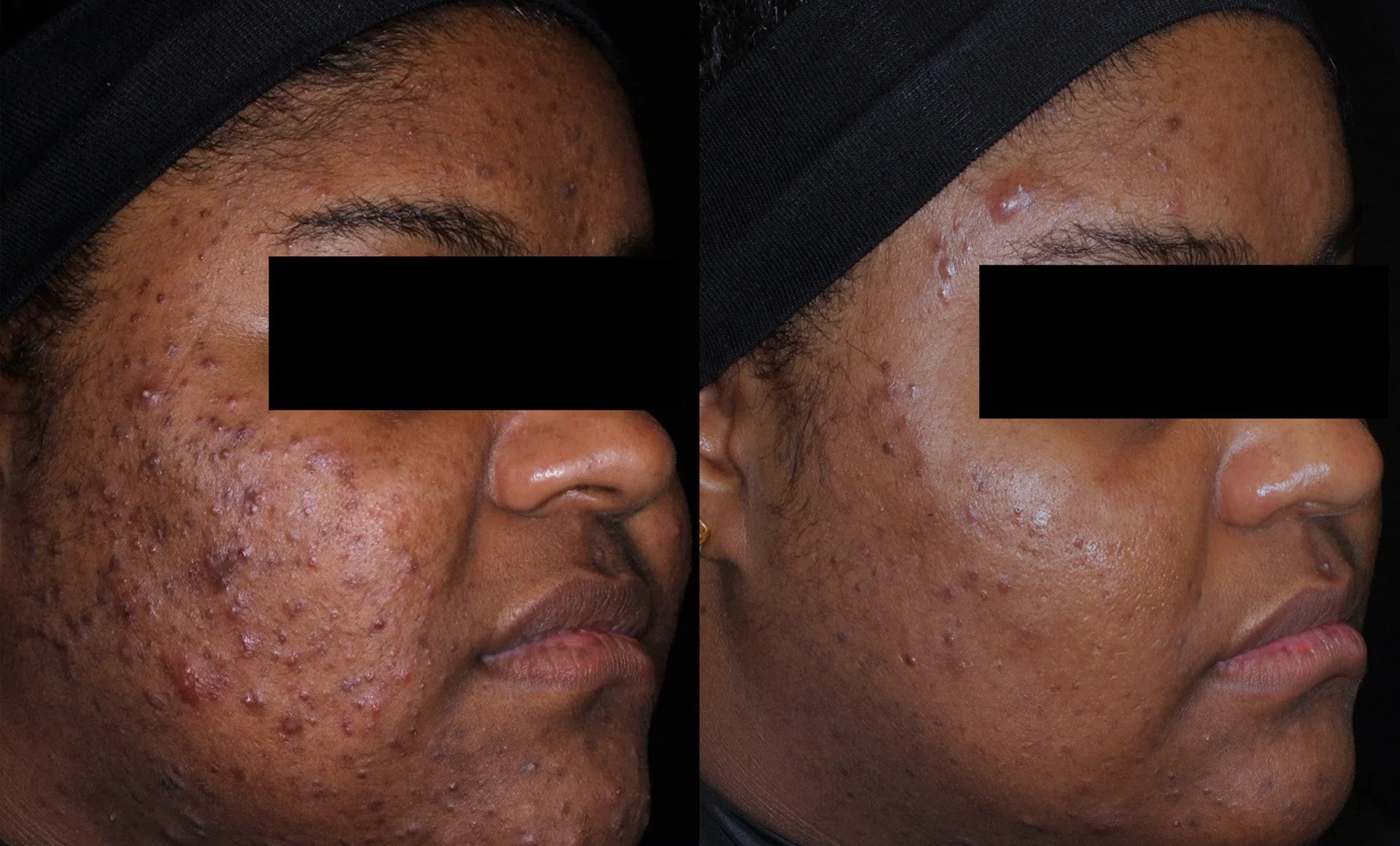 AviClear before and after treatment results
