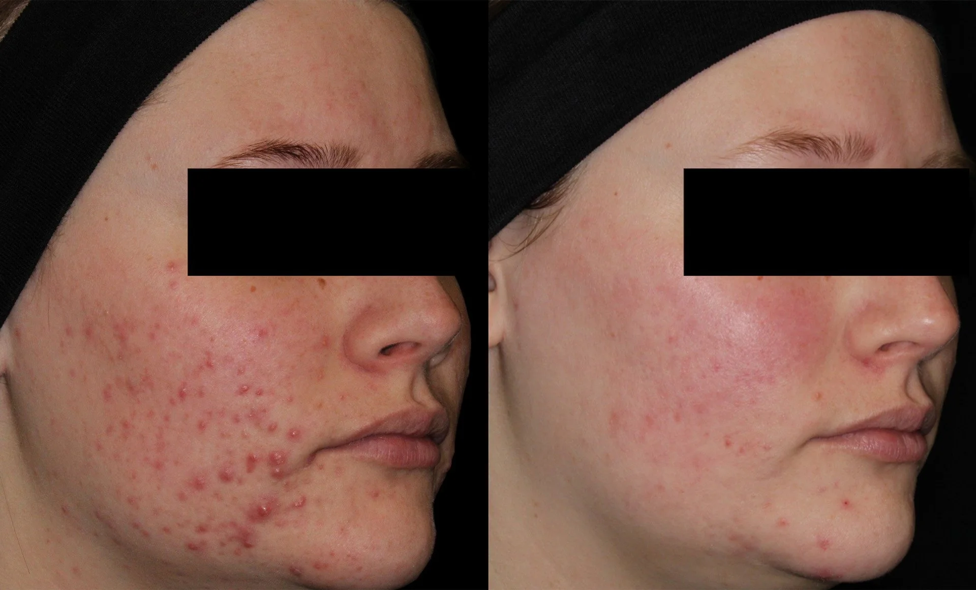 AviClear before and after treatment results