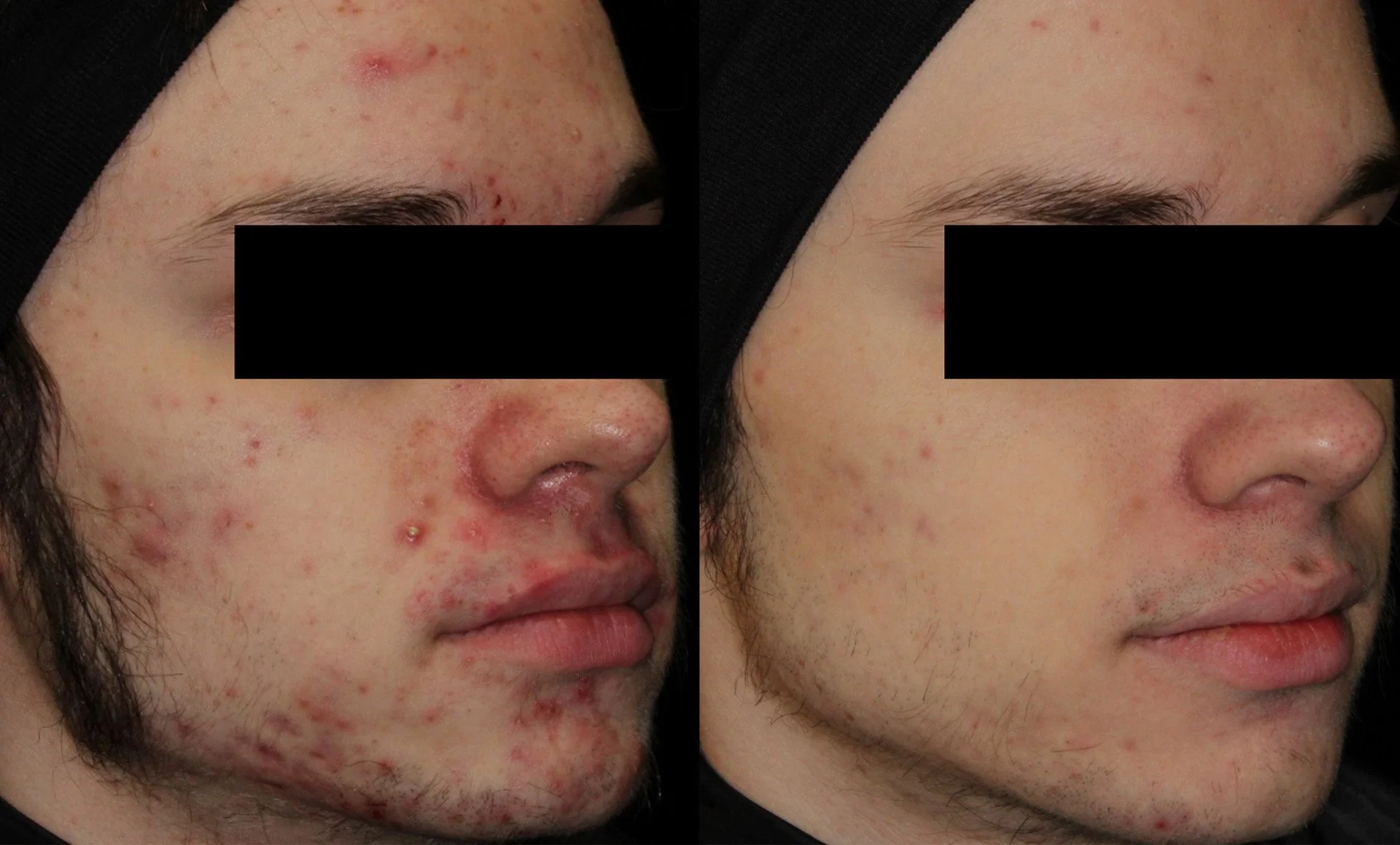 AviClear before and after treatment results
