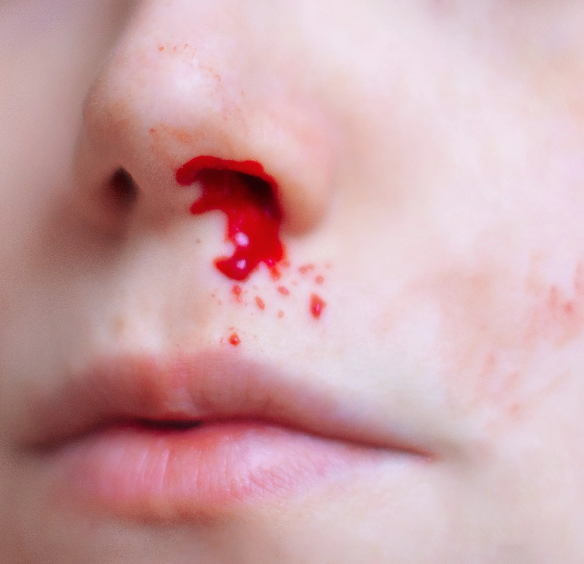 Un visage d'enfant avec du sang coulant de la narine, des petits saignements autour du nez, et des lèvres légèrement closes.