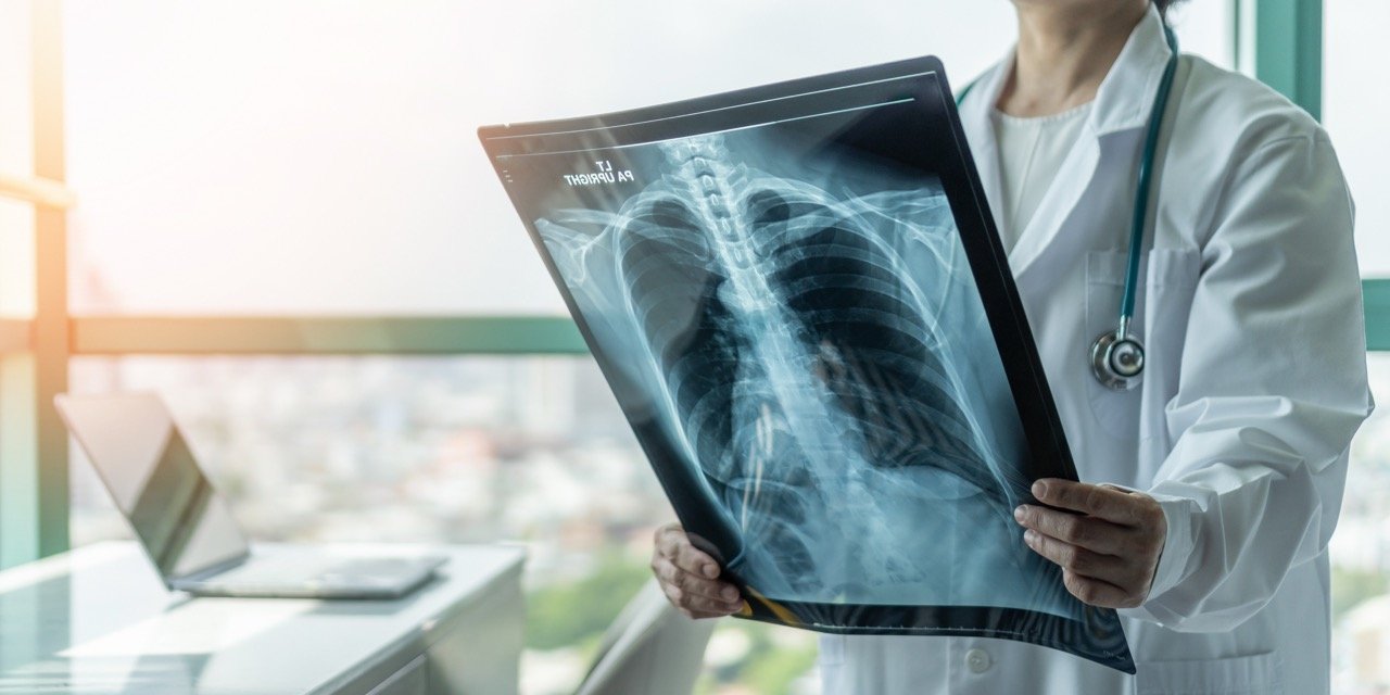 When RRP Spreads to the Lungs: Understanding a Rare and Severe Adult-Onset Case