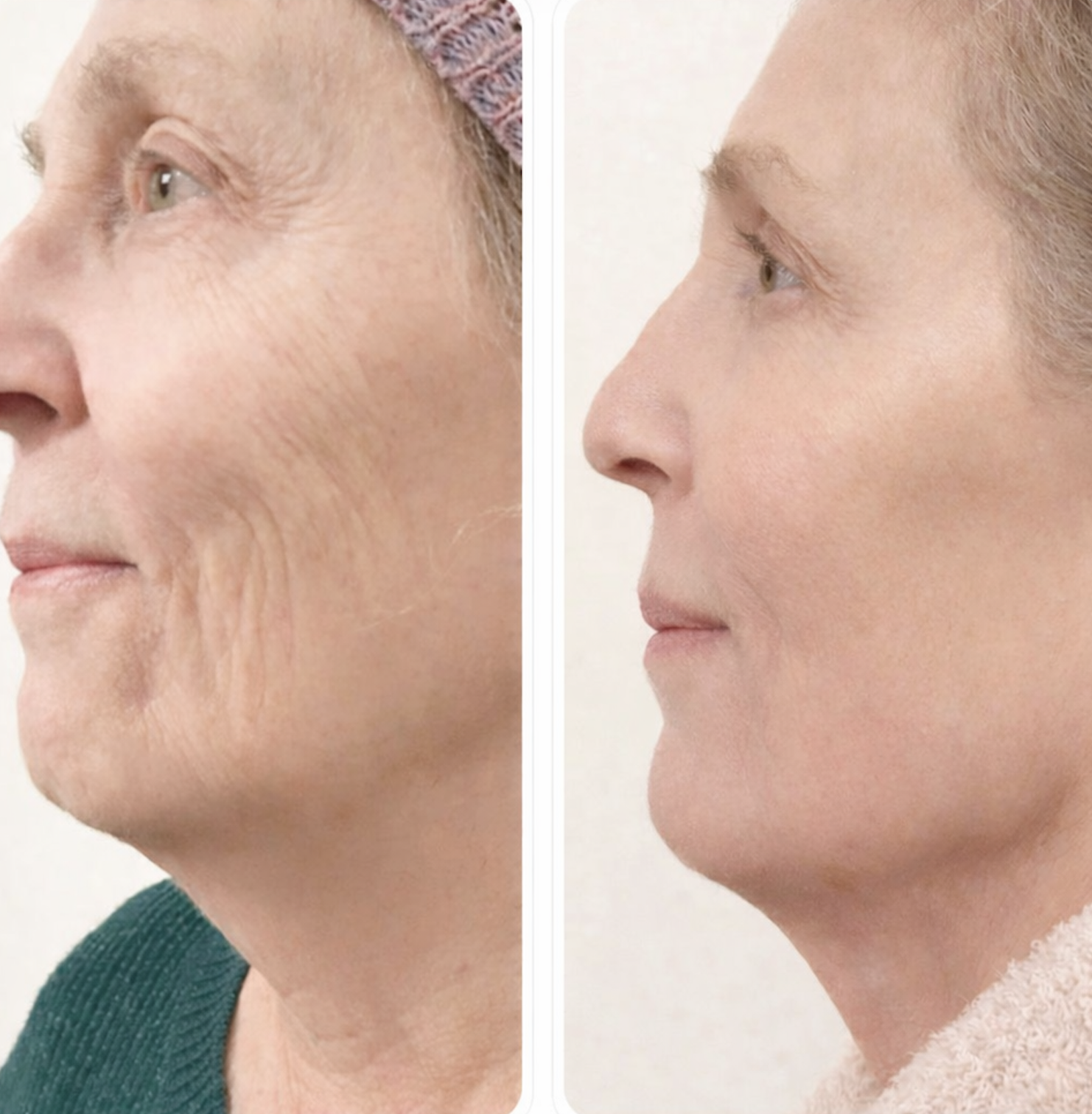 Résultat avant/après lifting coréen et soin anti-âge à L'Apogée — visage redéfini et rajeuni à Péchabou près de Toulouse.