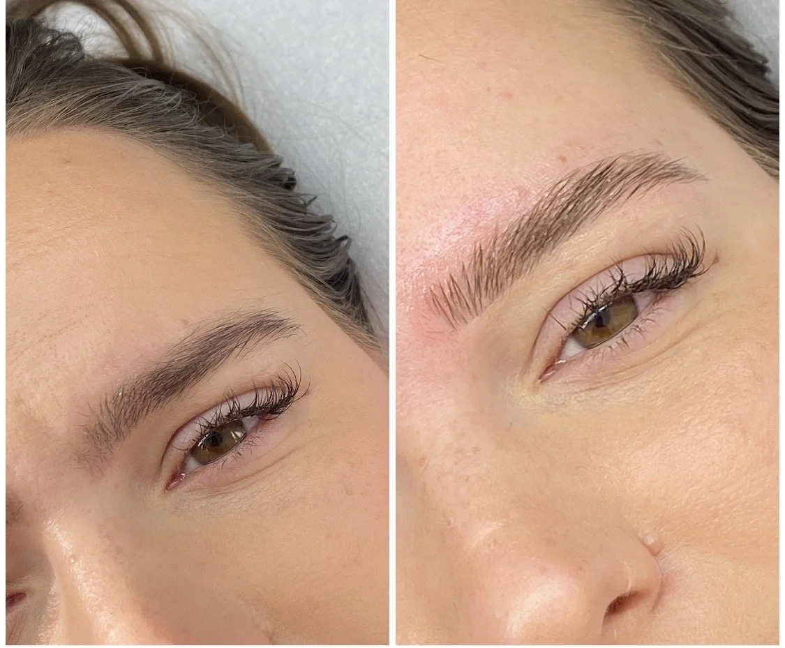 Restructuration sourcils browlift résultat avant après L'Apogée Péchabou Toulouse