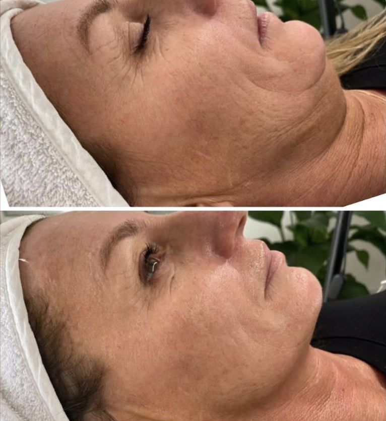 Résultat avant/après soin du visage à L'Apogée — peau lissée, unifiée et lumineuse près de Toulouse.