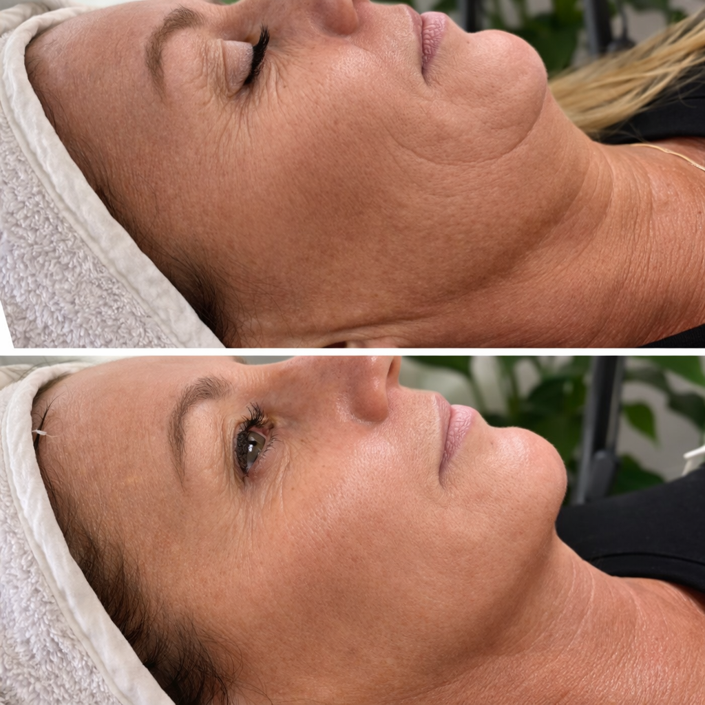 Résultat soin du visage à L'Apogée — hydratation, lifting coréen, éclat et rajeunissement cutané près de Toulouse.