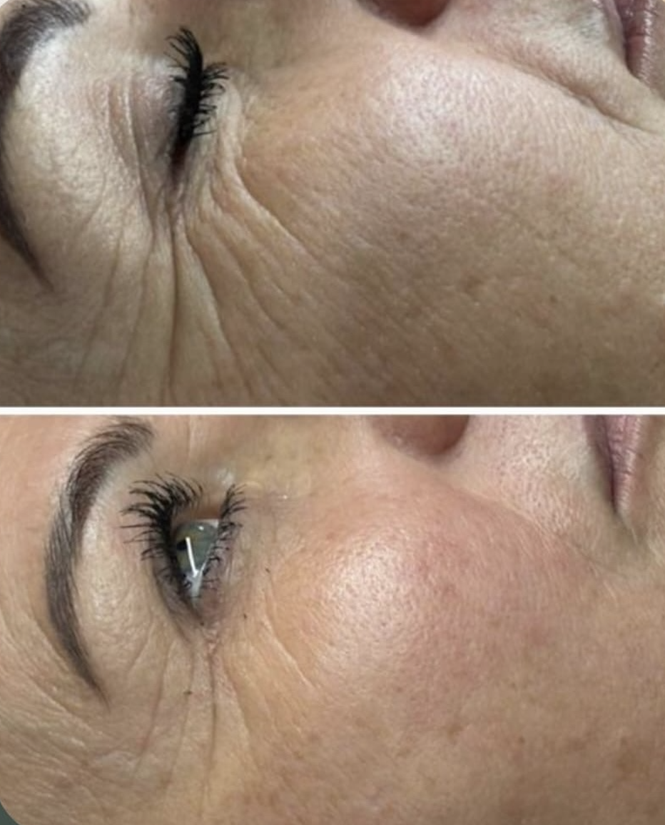 Résultat avant/après soin anti-âge à L'Apogée — réduction des rides et rajeunissement cutané à Péchabou près de Toulouse.