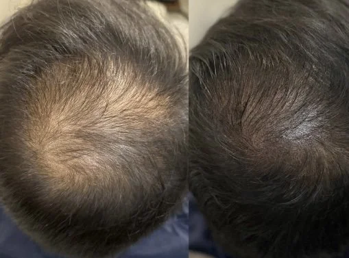 Scalp Micropigmentation