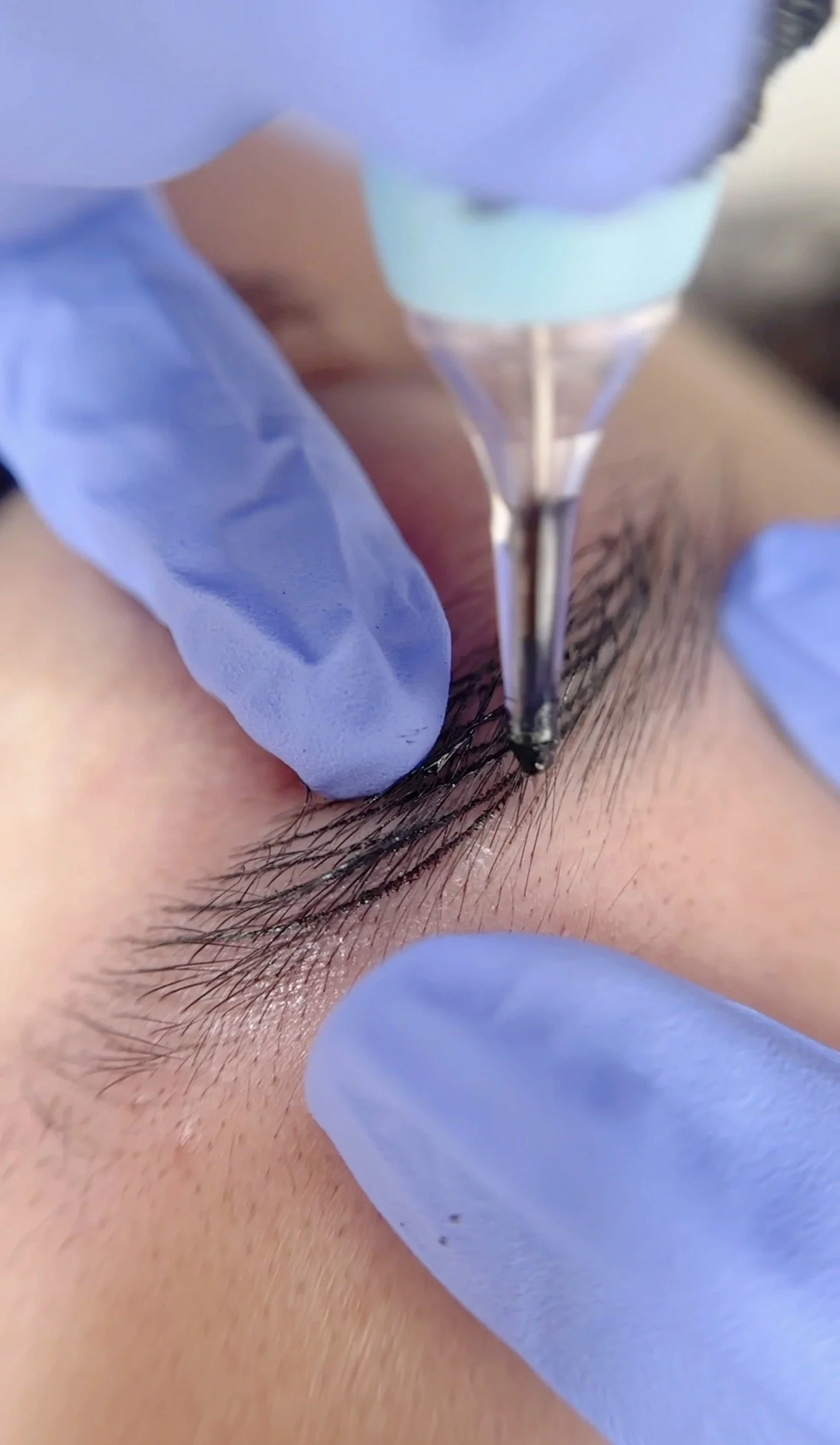Close-up of a person receiving an eye injection with a syringe, wearing blue gloves.