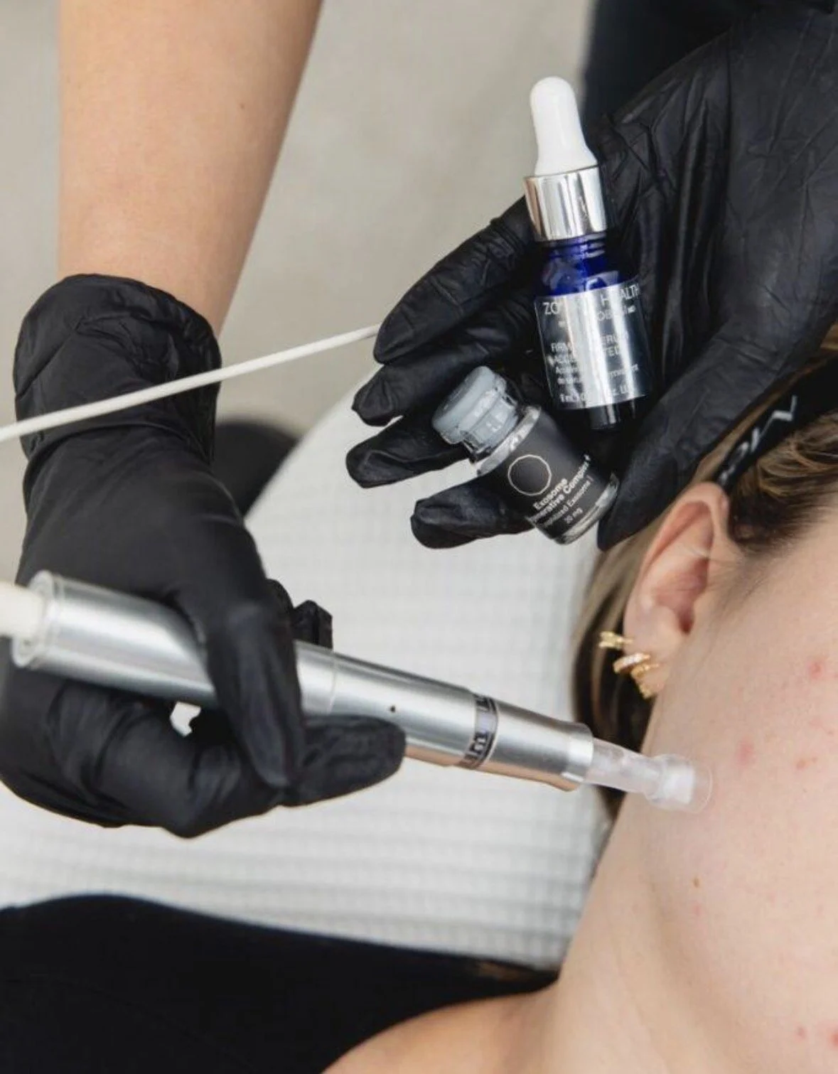 Microneedling with Nano Exosomes