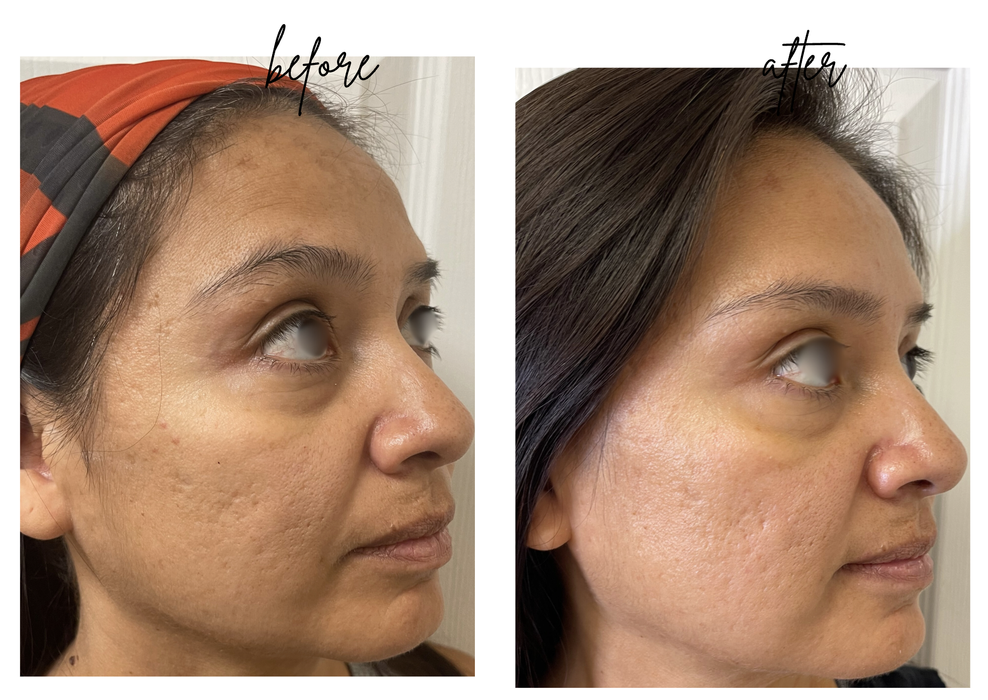 Derma fillers