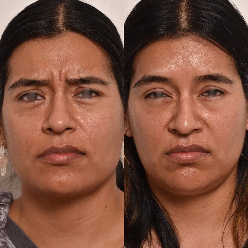 Wrinkle Relaxers