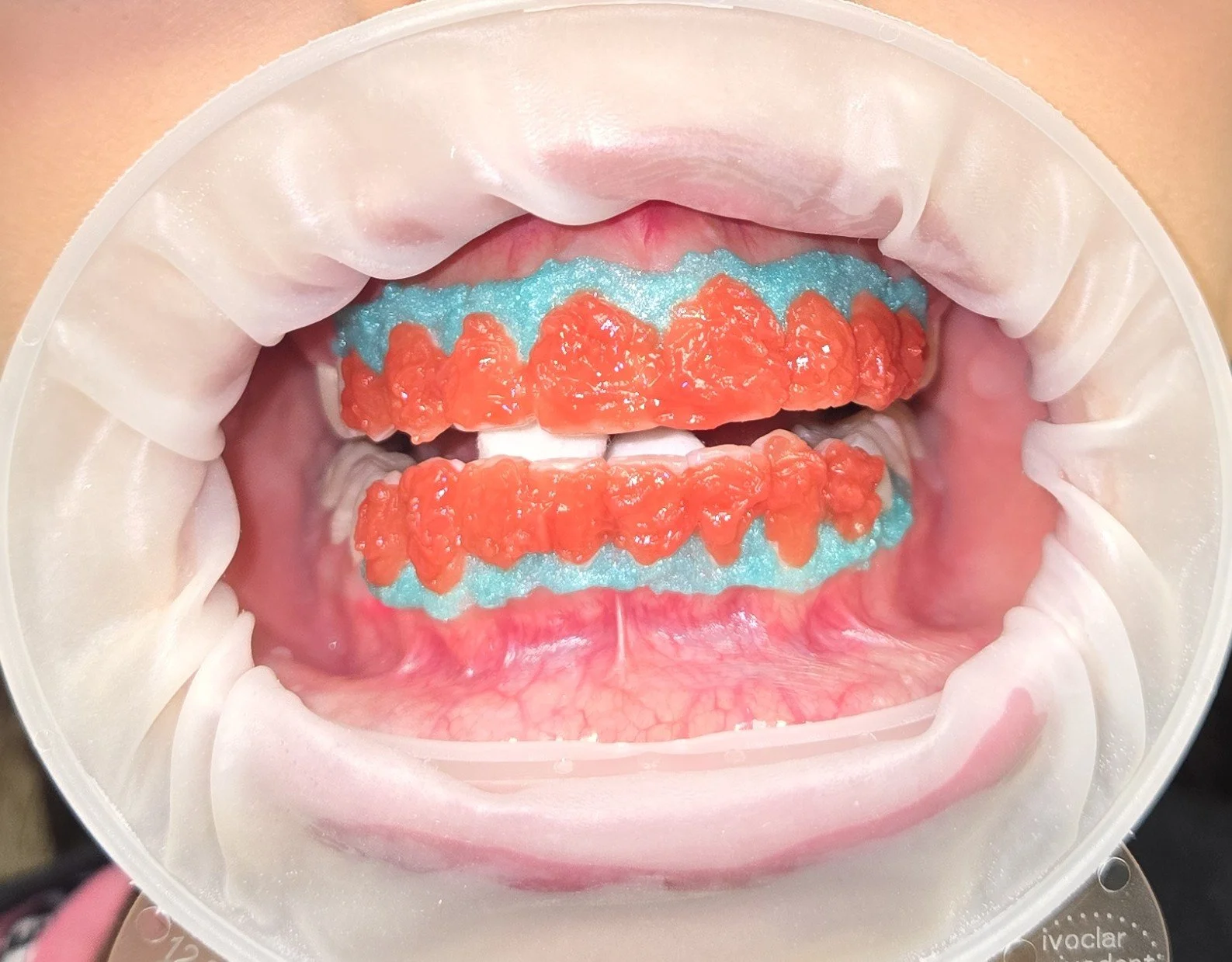 Close-up of professional teeth whitening procedure with protective isolation and whitening gel applied to teeth in dental office