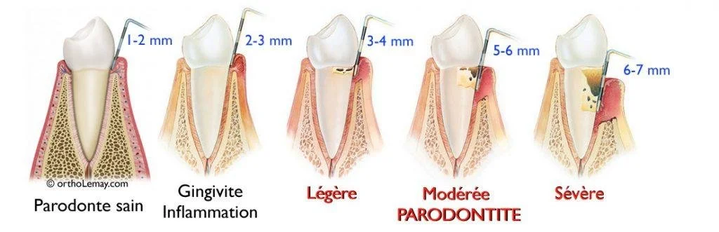 periodontal probing pocket depth chart showing healthy gums gingivitis and periodontitis stages dentist Fox Point WI gum disease treatment near Bayside Shorewood Glendale
