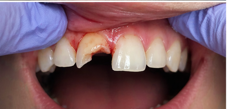 Close-up of chipped and broken front tooth from dental trauma treated with emergency dentistry in Fox Point Wisconsin.