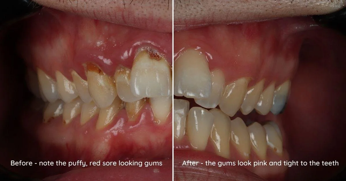 PerioDT gum disease treatment before and after showing reduction of inflammation and healthier gums Fox Point WI periodontal therapy near Bayside Shorewood Glendale