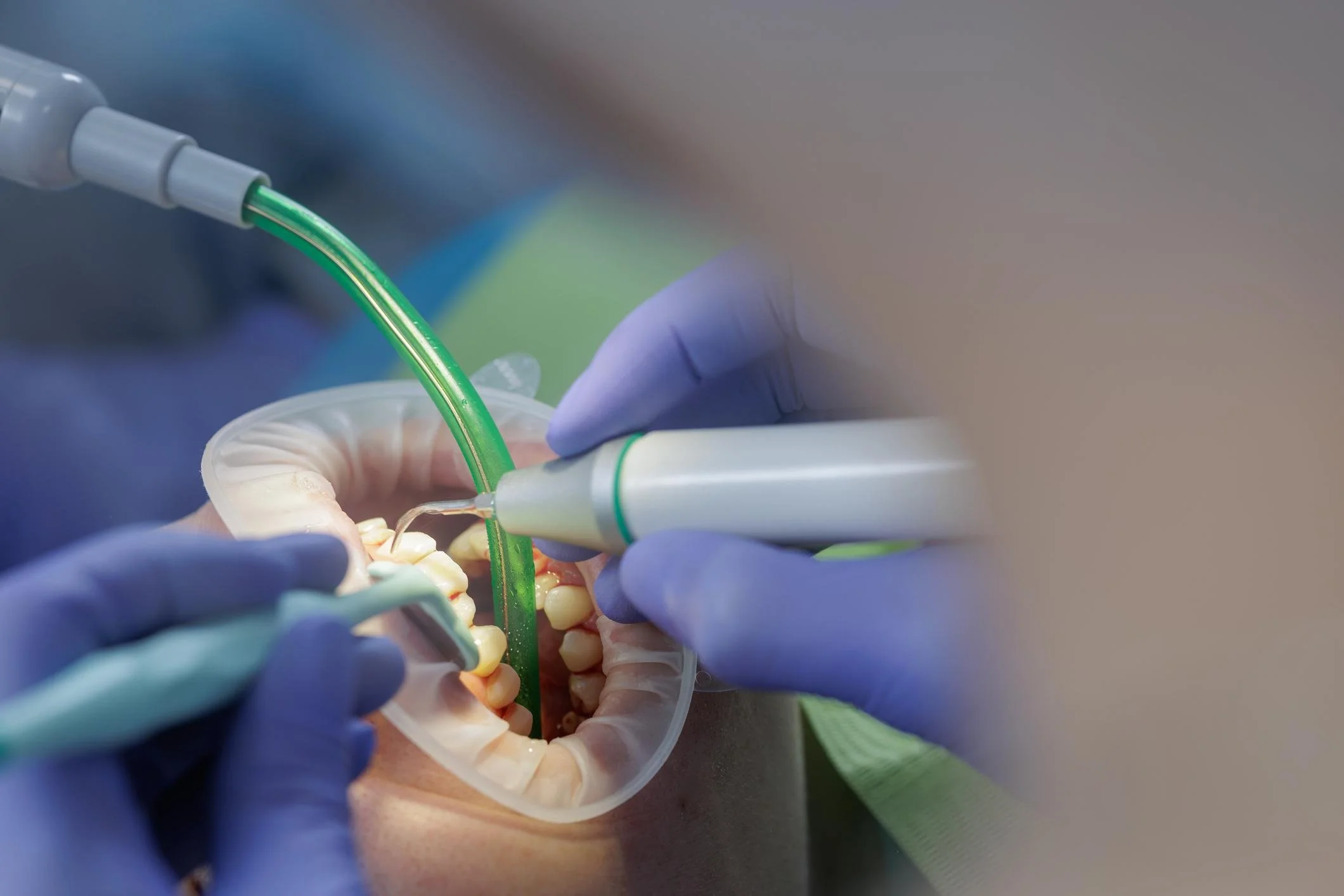 ultrasonic dental scaling removing plaque and tartar during deep cleaning procedure Fox Point WI gum disease treatment near Bayside Shorewood Glendale