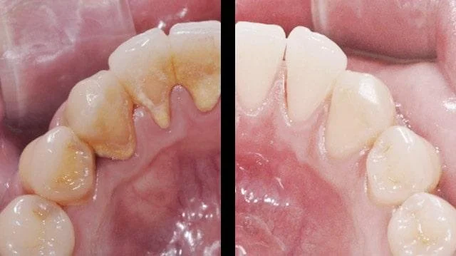 deep cleaning before and after tartar removal scaling and root planing results gum disease treatment Fox Point WI dentist near Bayside Shorewood Glendale