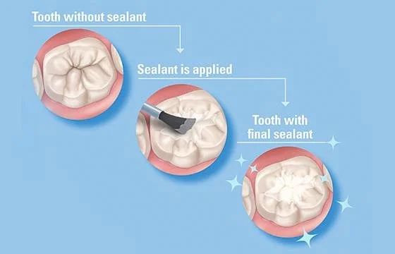 dental sealants application preventing cavities on molars Fox Point WI preventive dentistry for children and adults near Bayside Shorewood Glendale