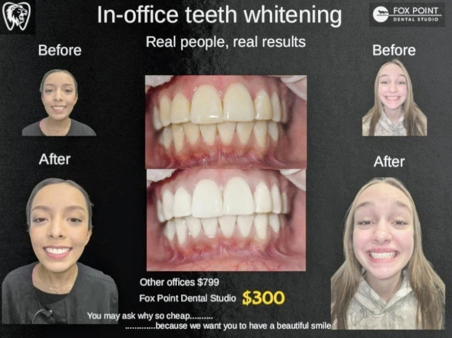 In-office teeth whitening before and after results showing brighter, whiter smile at Fox Point Dental Studio in Milwaukee Wisconsin