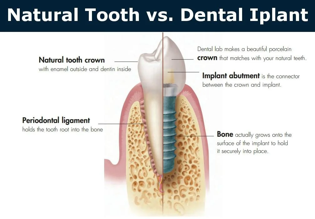 natural tooth vs dental implant comparison showing crown abutment and implant structure dental implant education Fox Point WI implant dentist near Bayside Shorewood Glendale