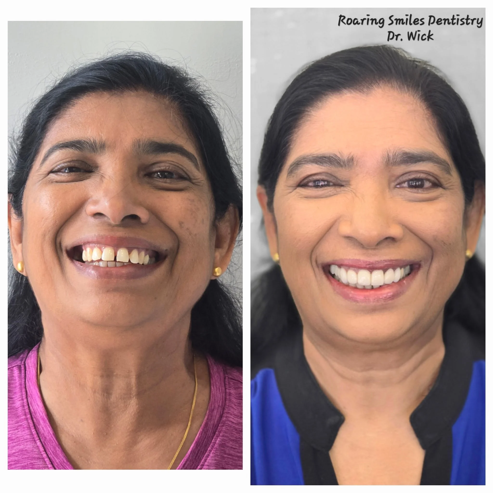 before and after smile makeover cosmetic dentistry results Fox Point WI veneers whitening smile transformation near Bayside Shorewood Glendale