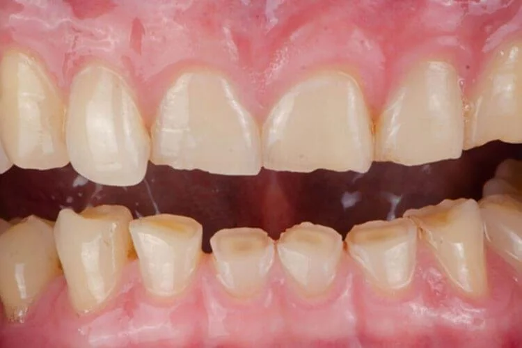 Severely worn teeth caused by grinding and bruxism requiring restorative dental treatment in Fox Point Wisconsin.