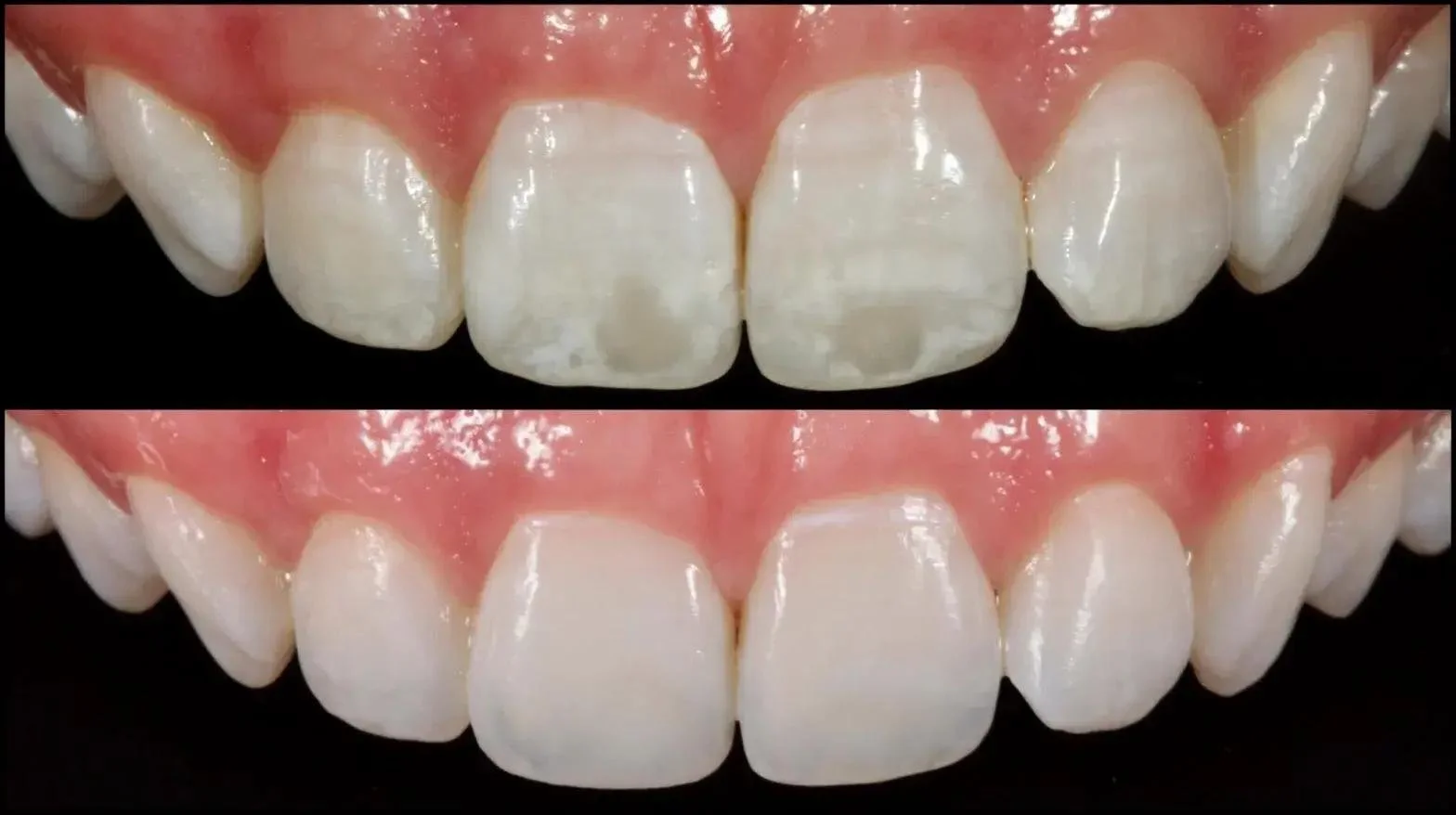 Images shows results after application of ICON white spot treatments on teeth showing drastic improvement and minimally invasive technique