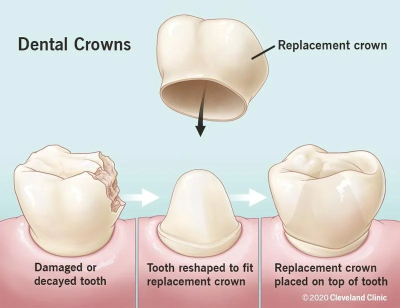 dental crown procedure diagram showing damaged tooth reshaping and crown placement Fox Point WI dentist near Bayside Shorewood Glendale