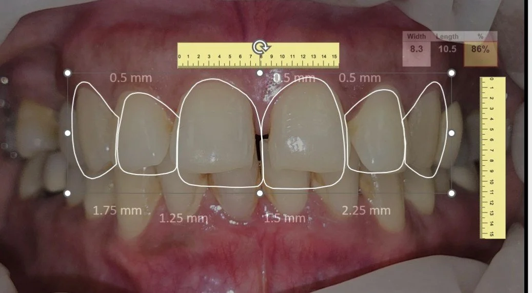 digital smile design analysis with tooth proportions and measurements cosmetic dentistry planning Fox Point WI smile makeover near Bayside Shorewood Glendale