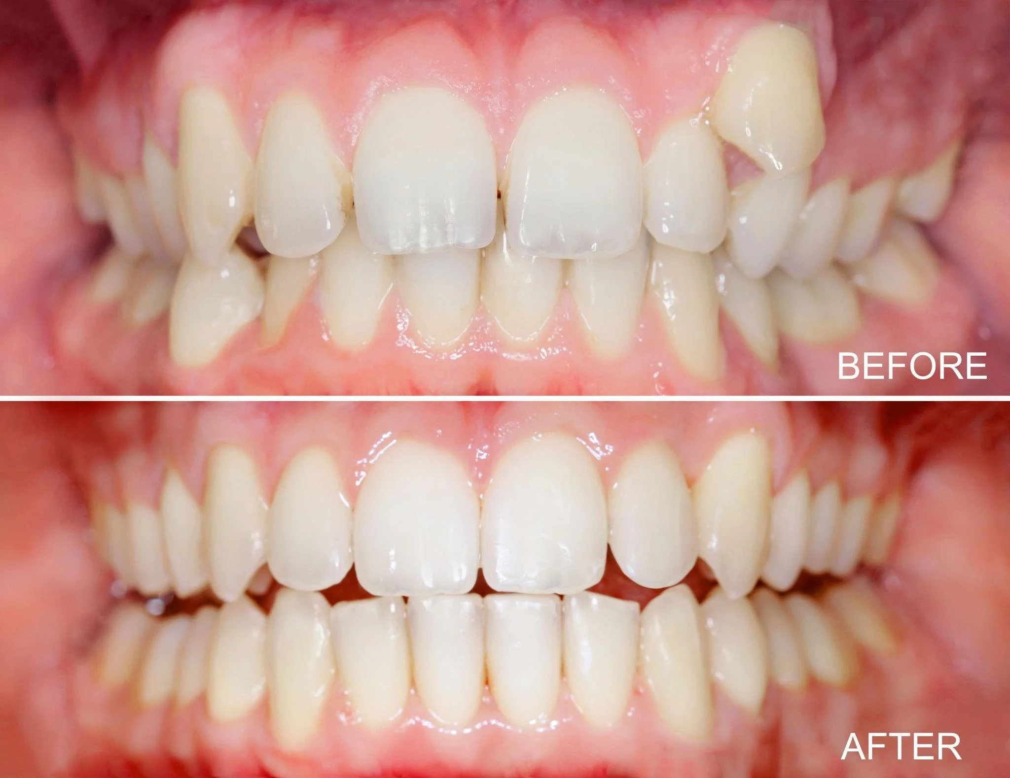 Before and after invisialign suresmiles clear braces faster result in fox point, wi