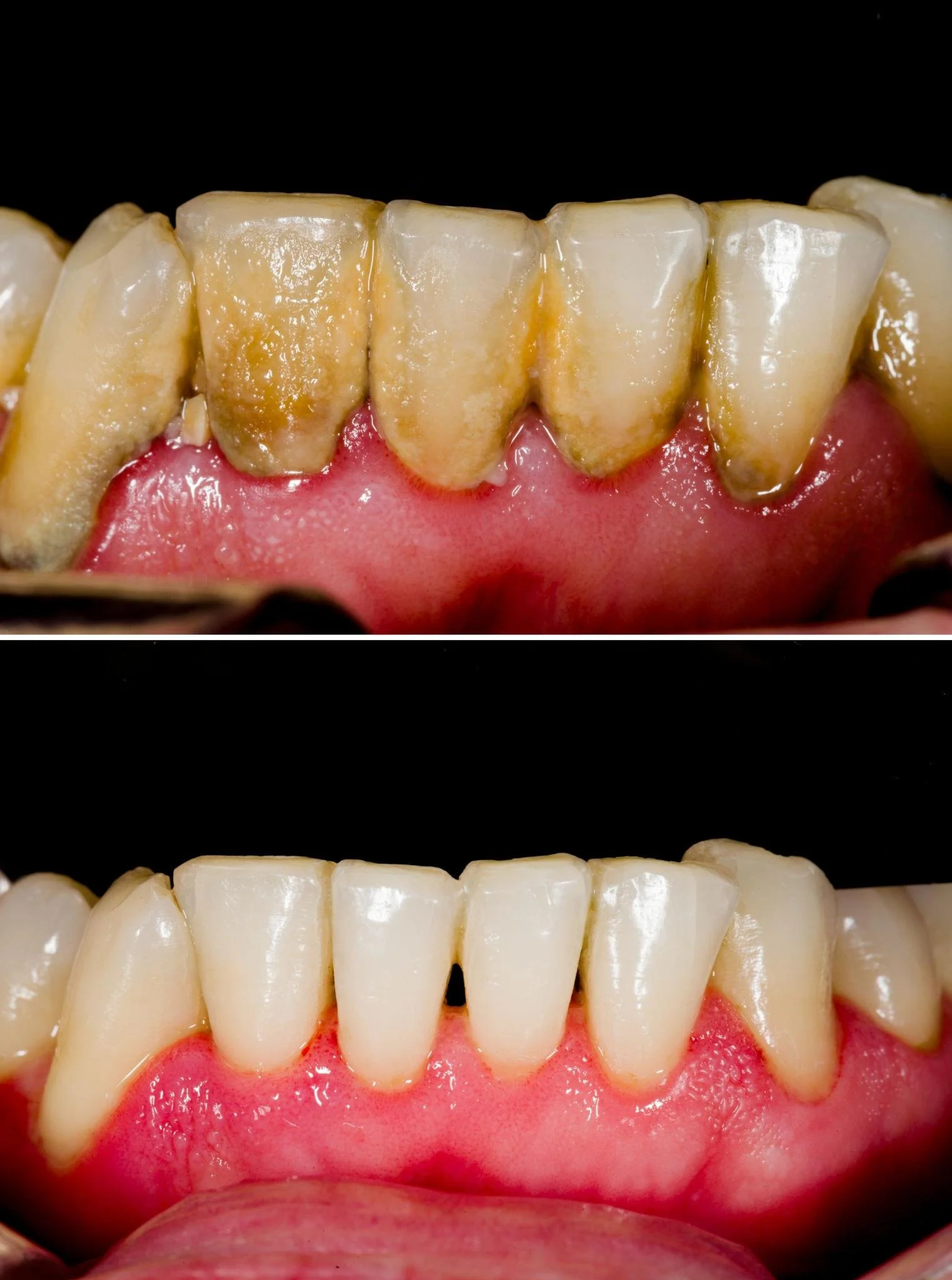 deep cleaning before and after tartar and calculus removal from lower teeth scaling and root planing results gum disease treatment Fox Point WI dentist near Bayside Shorewood Glendale