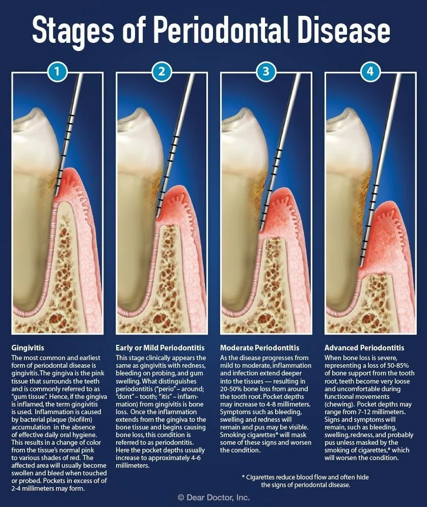 periodontal probing pocket depth chart showing healthy gums gingivitis and periodontitis stages dentist Fox Point WI gum disease treatment near Bayside Shorewood Glendale
