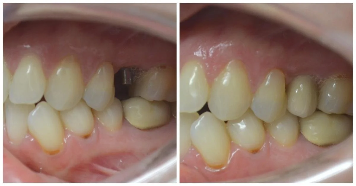dental implant with crown replacing missing tooth before and after results Fox Point WI implant dentist near Bayside Shorewood Glendale